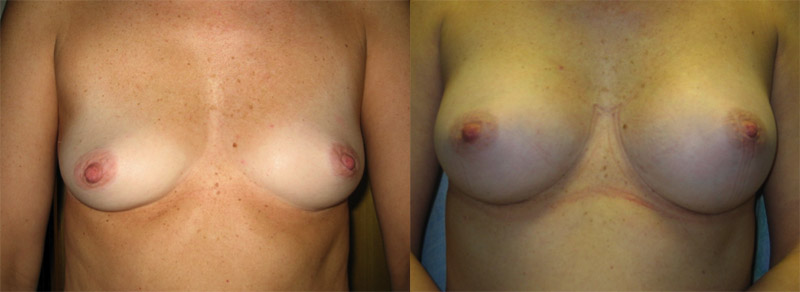 breastaugmentationcase0189